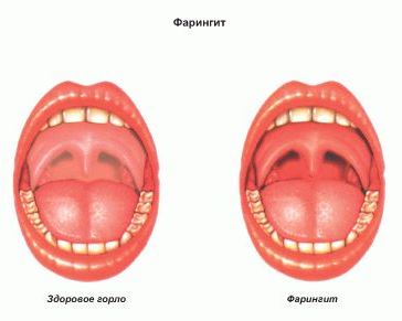 Изображение 1: Фарингит - Кабинет семейного врача